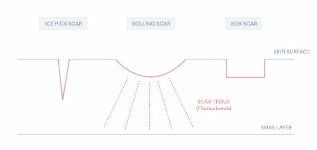Skin Booster for Acne Scar Treatment | Mizu
