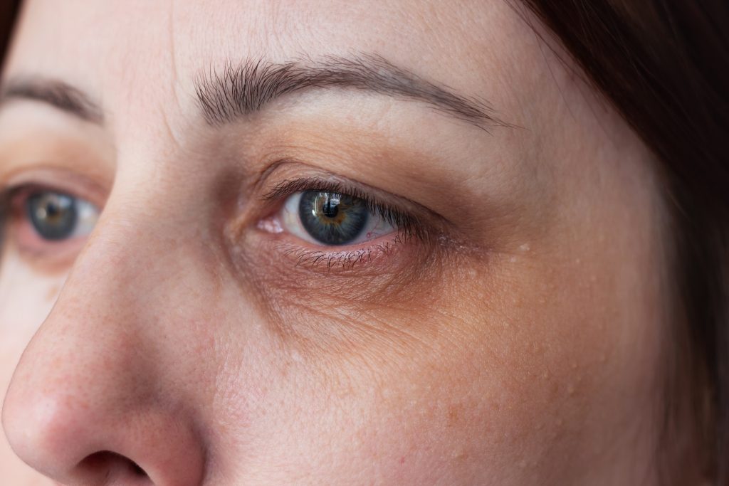 Eyebags and Dark Circles Issues | Mizu