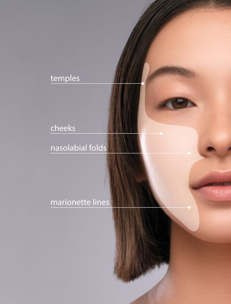 Sculptra Treatment Areas | Mizu