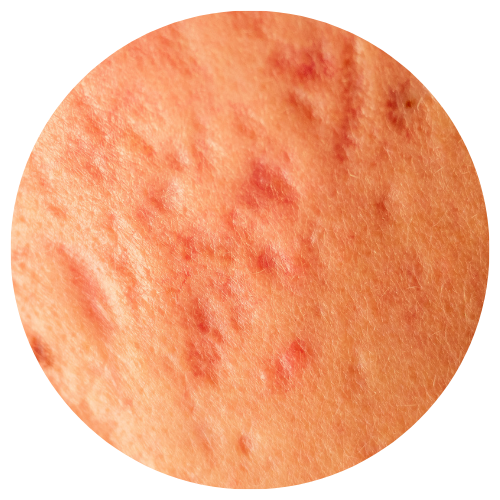 Acne Scars | Mizu