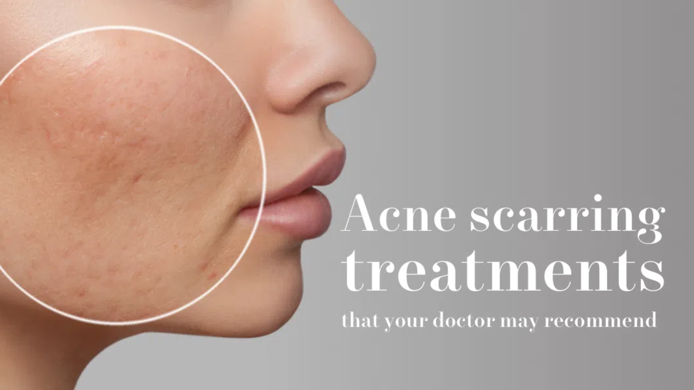 Acne Scarring Treatment That Your Doctor May Recommend | Mizu