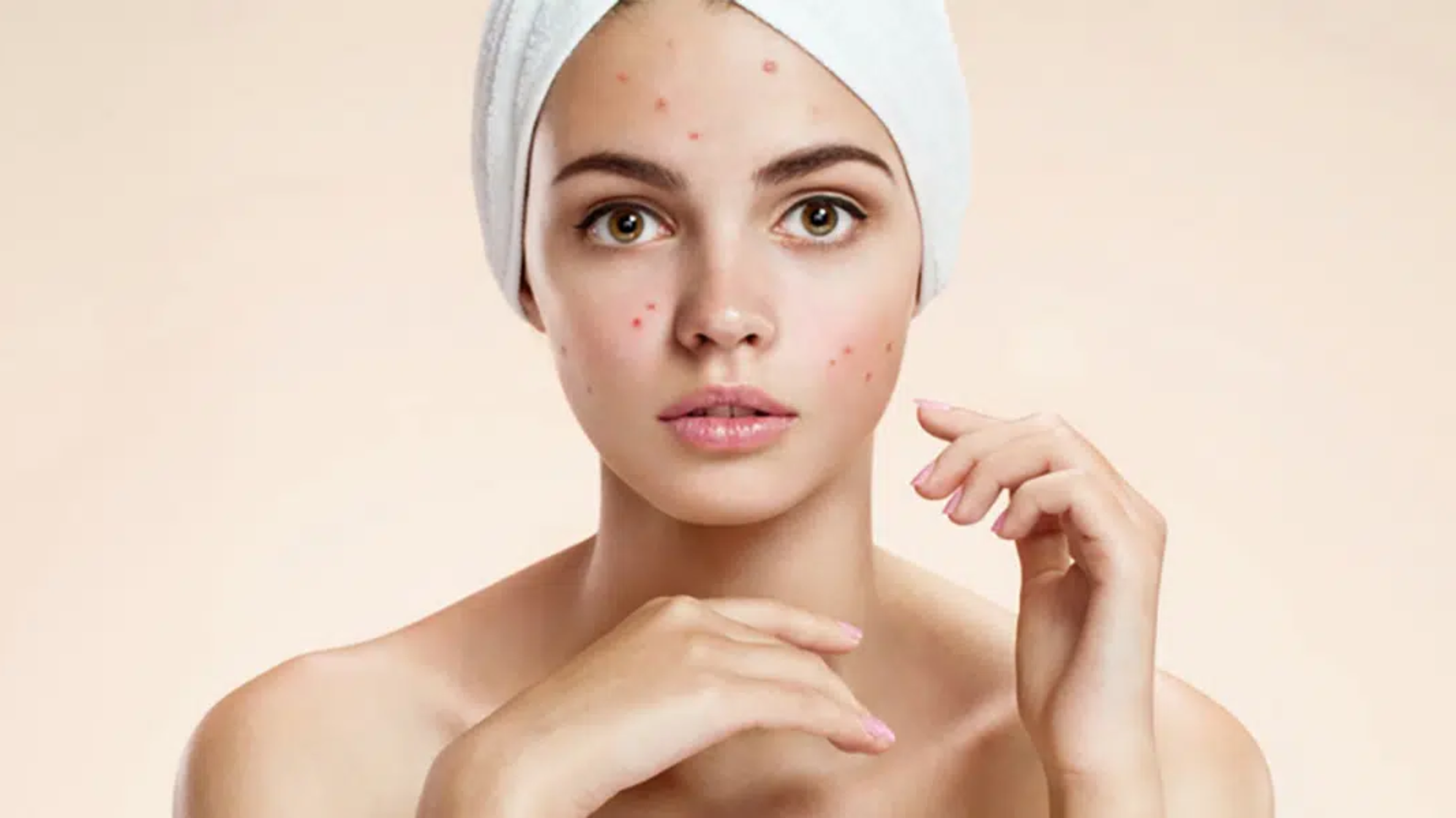 All About Acne | Mizu