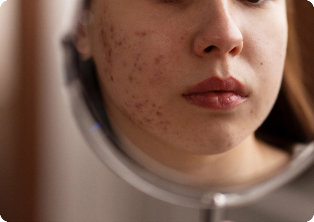 Managing Acne Scars | Mizu