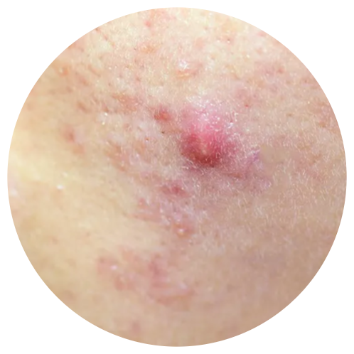 Acne - Papules | Mizu