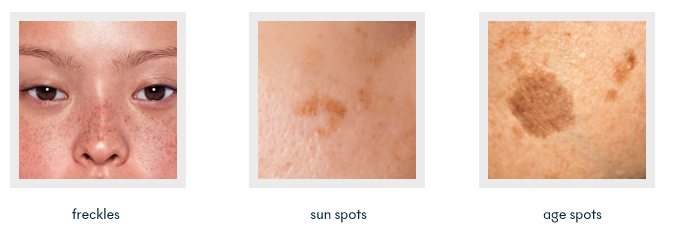 Types of Pigmentation | Mizu