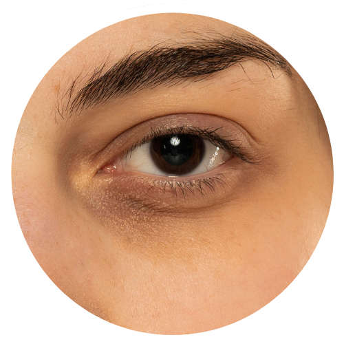 Dark Circles Concerns_Pigmented | Mizu