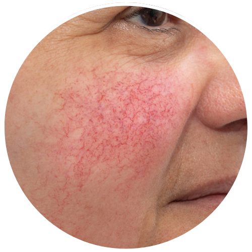 Rosacea - Redness and Flushing | Mizu