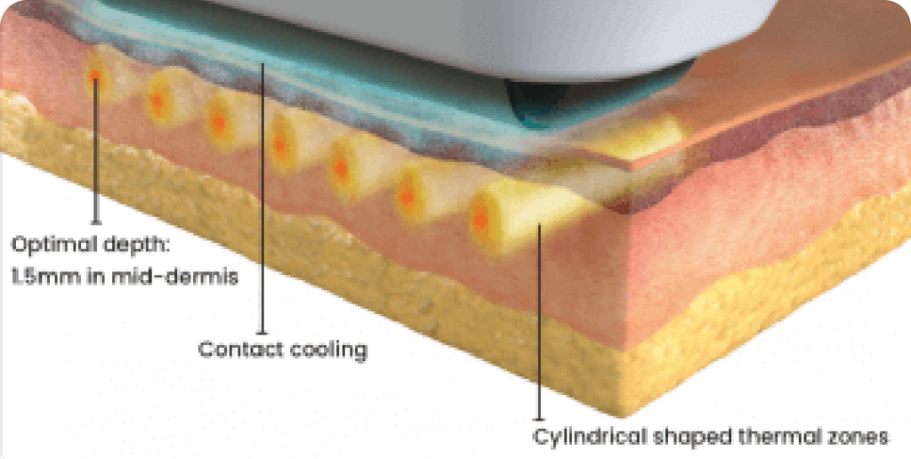 Sofwave Treatment | Mizu