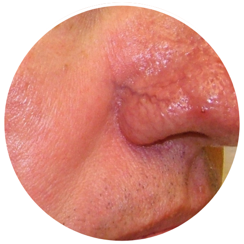 Rosacea - Thick Skin | Mizu