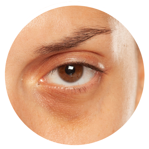 Dark Circles Concerns_Vascular | Mizu