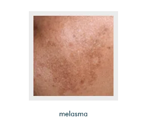 An Honest Doctor's Guide to Treating Pigmentation | Mizu
