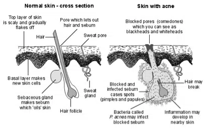 Normal Skin - Cross Section vs Skin with Acne | Mizu