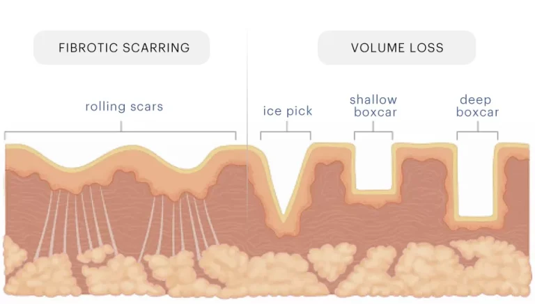 Acne Scarring Treatments: Fibrotic Scarring vs Volume Loss | Mizu