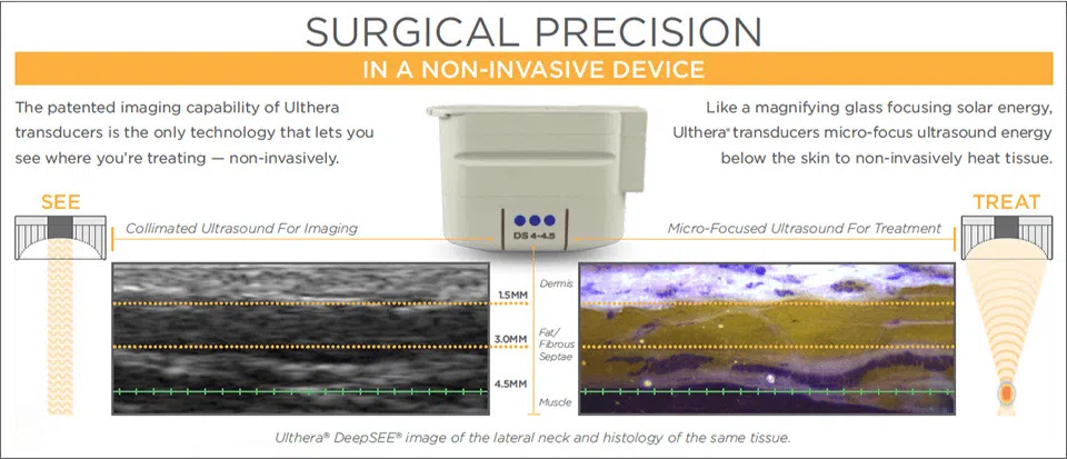 Ultherapy - Surgical Precision in a Non-Invasive Device | Mizu