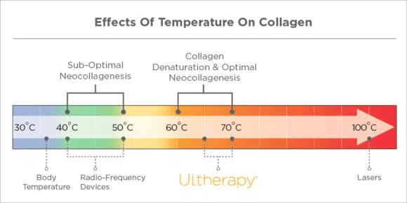 Ultherapy - Effects of Temperature on Collagen | Mizu