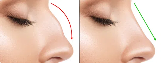 Nose Fillers | Mizu