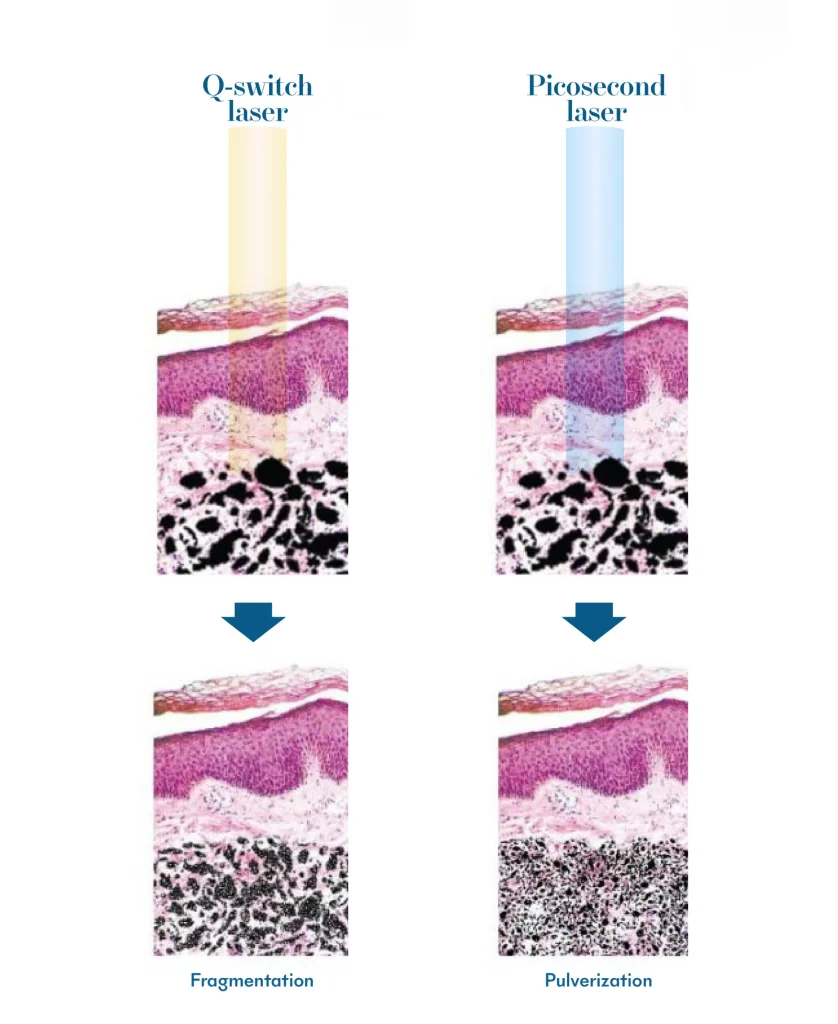 Q-switch Laser vs Picosecond Laser | Mizu