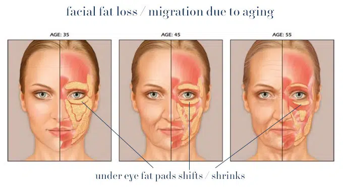 Undereye Fillers - Dark Eye Circles Treatment | Mizu