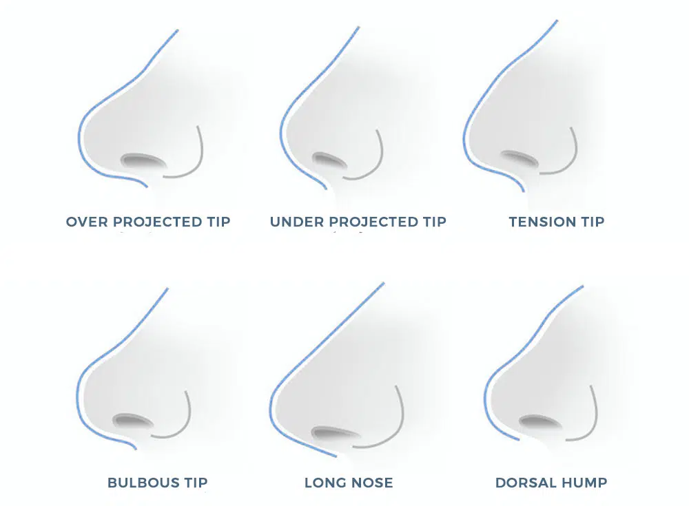 Nose Fillers: Types of Noses | Mizu