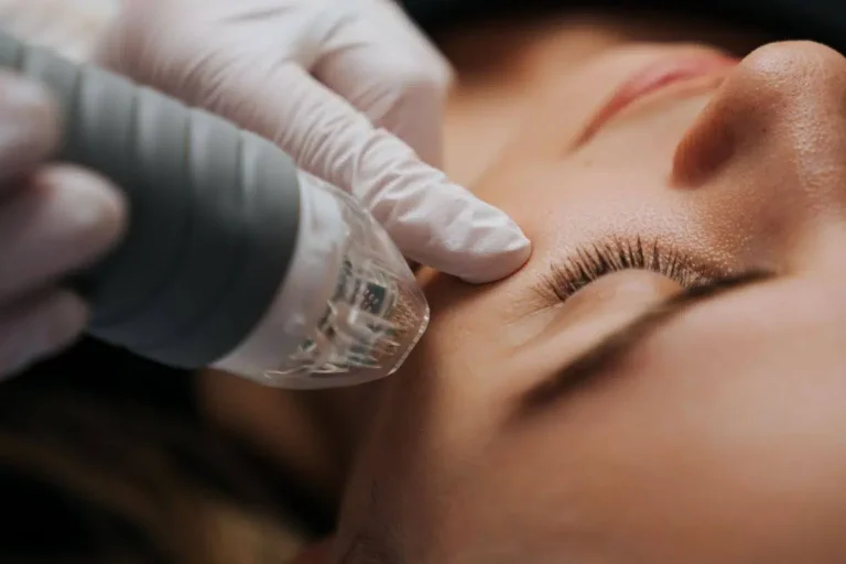 Woman Undergoing Radiofrequency MIcroneedling | Mizu